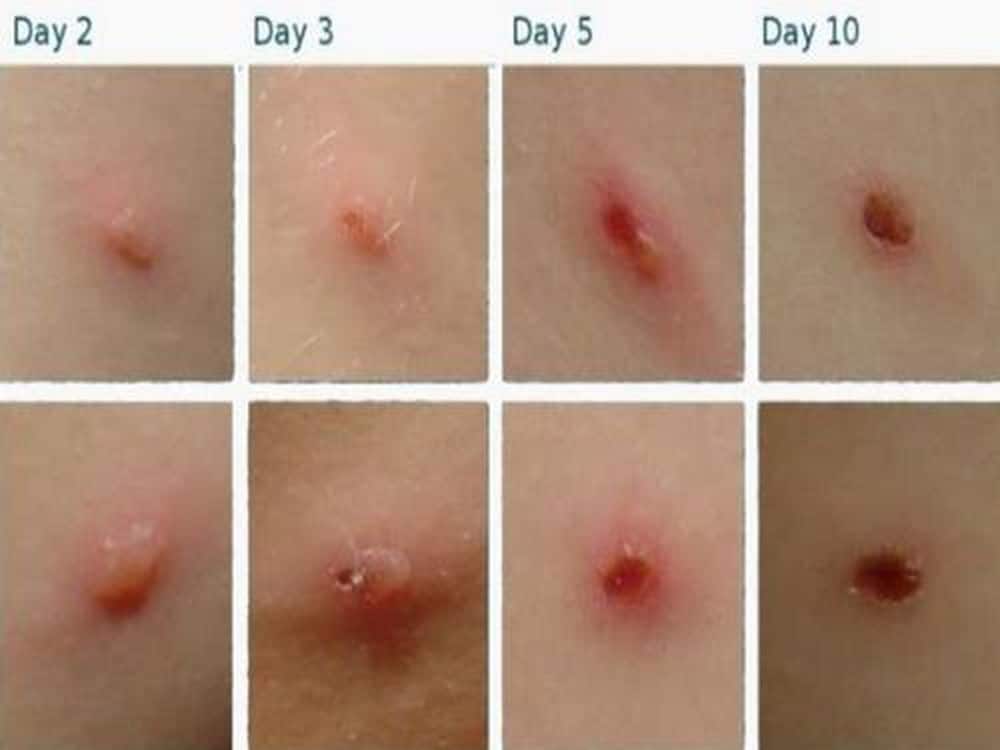 chickenpox lesions start as a flat papule, before filling with liquid. Over time the lesions will crust.