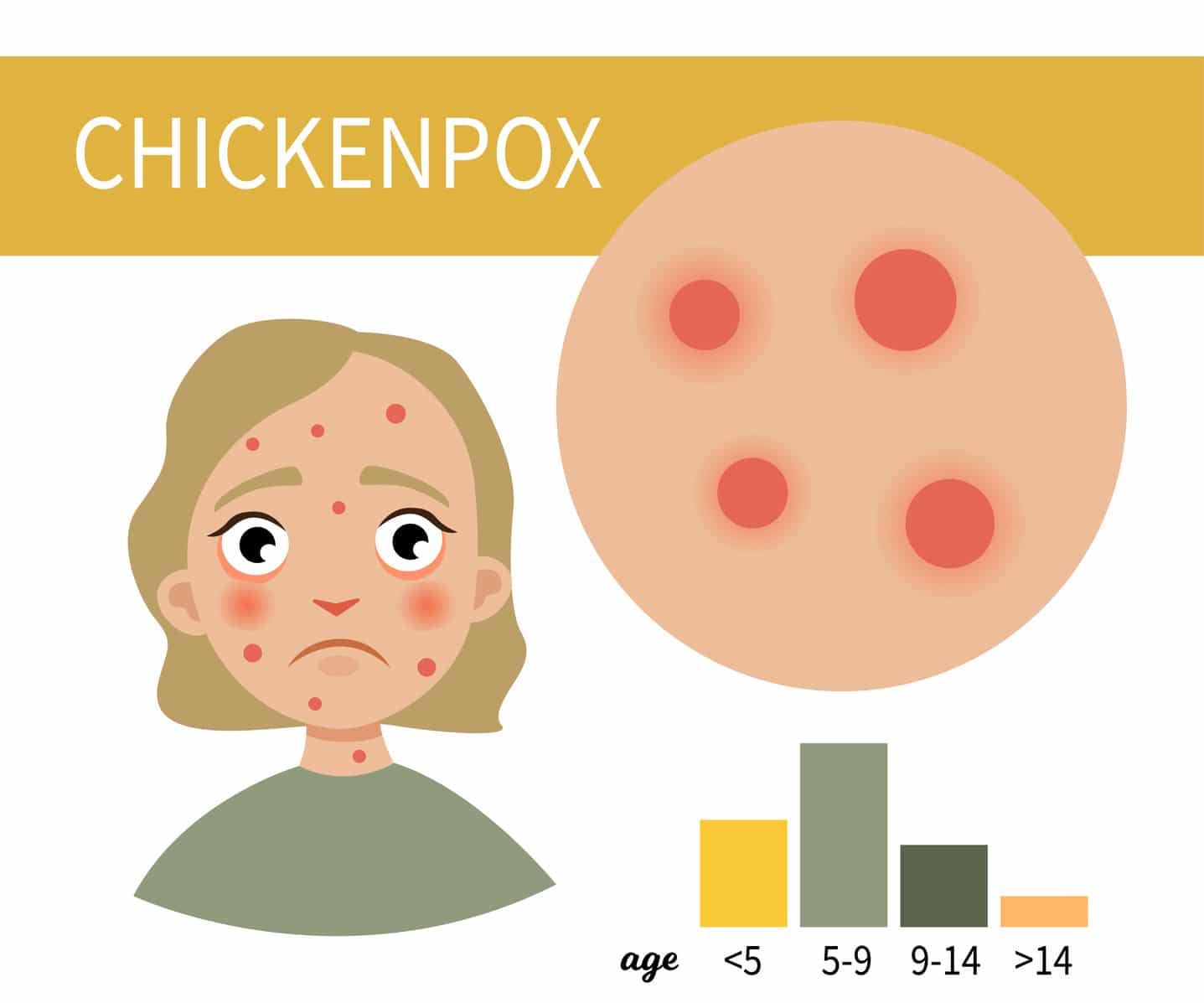 chickenpox is most common in children under the age of 14, especially children between the ages of 5-9.