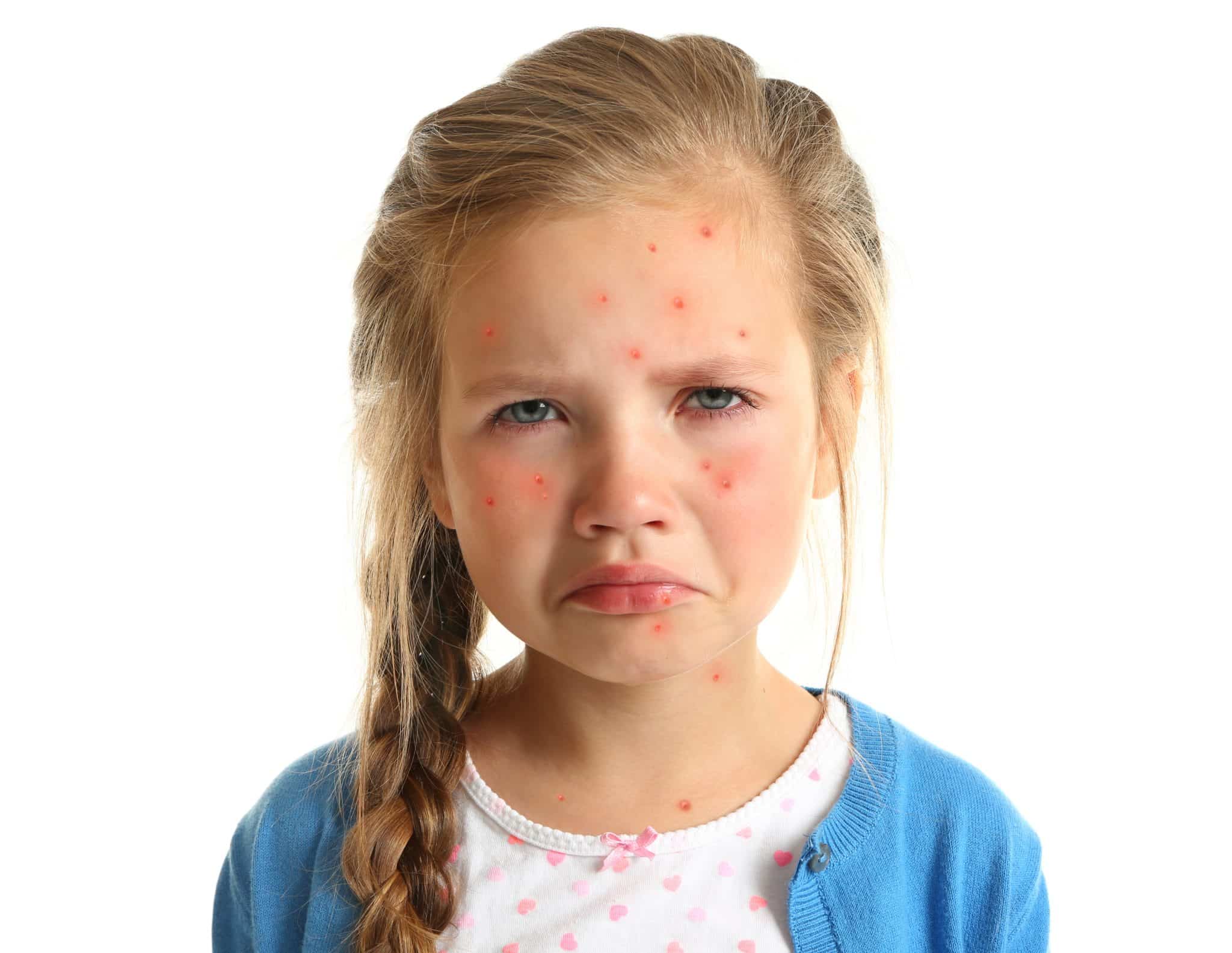 Female child frowning with chickenpox on her face and neck