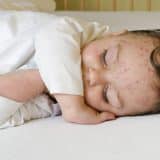 Baby sleeping with chicken pox on their face and arms